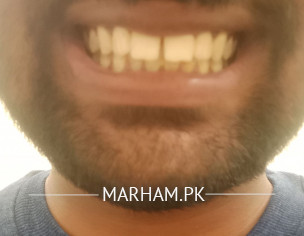 Gap In Upper Front Teeth