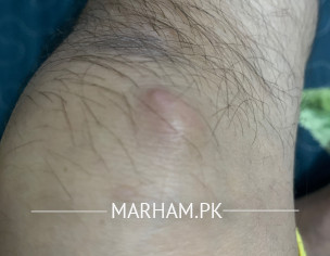 Unknown Bump On Knee