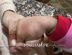 Scabies(Skin Problem)