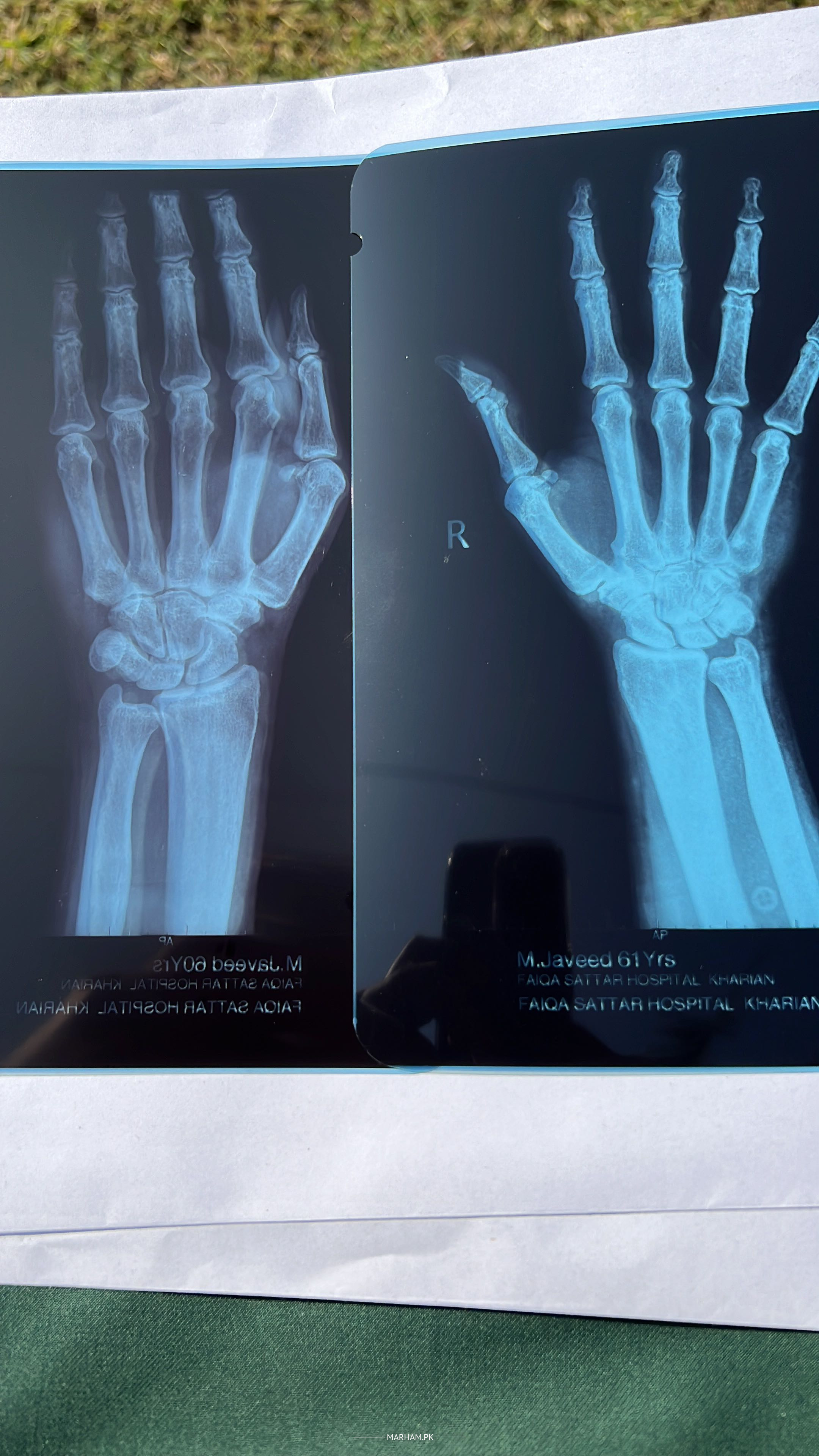 Ask a Physiotherapist Online for Wrist Joint Pain