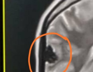  Meningioma Or Cavernoma