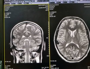  Meningioma Or Cavernoma