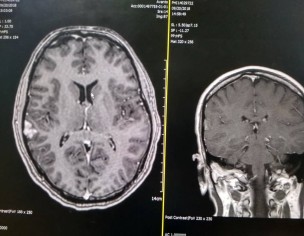  Meningioma Or Cavernoma