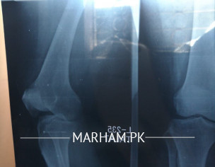 Knee Pain And Joint Pain