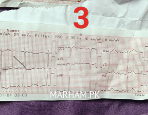 ECG