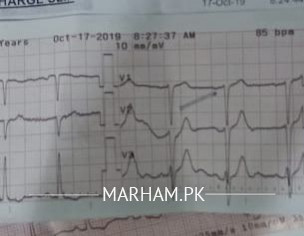 ECG