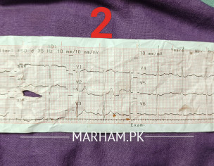 ECG