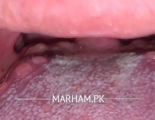 Inflammation / Mouth Dryness