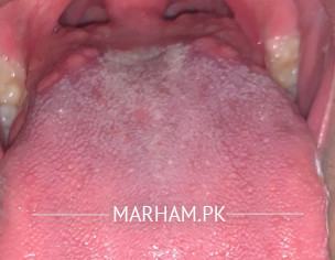 Inflammation / Mouth Dryness