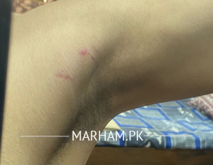 Red Marks Between Shoulders And Arm Pits