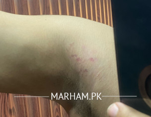 Red Marks Between Shoulders And Arm Pits