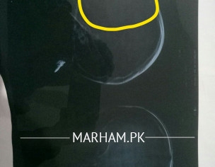 Right Frontal Sclap Foreign Body