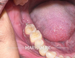 Wisdom Tooth Pain Swelling 