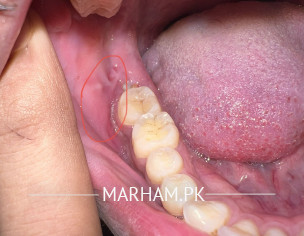 Wisdom Tooth Pain Swelling 