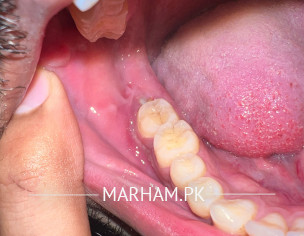 Wisdom Tooth Pain Swelling 