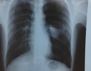 Pain In Left Side Chest