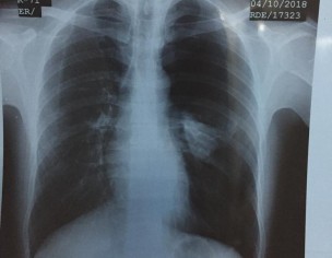 Pain In Left Side Chest