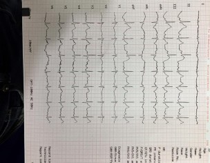 Pain In Left Side Chest