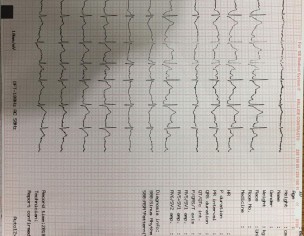 Pain In Left Side Chest