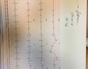 Pain In Left Side Chest