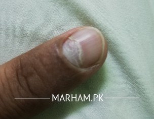 Nails Problem
