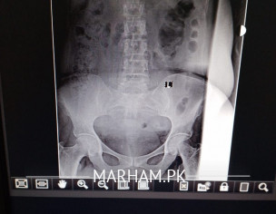 Backache For About A Month