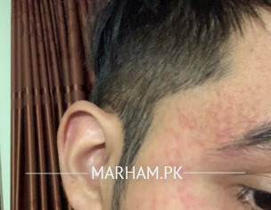 Skin Issue Red Bumps