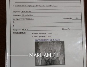 Avn Stage 2 And Arthritis