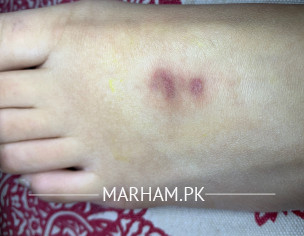 Burn Mark On Feet