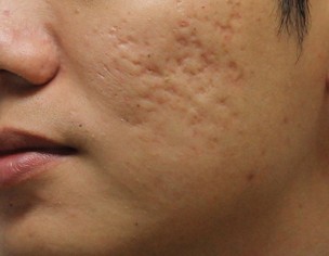 Acne Scar