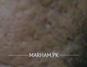 DEEP SCARS ON CHEEKS