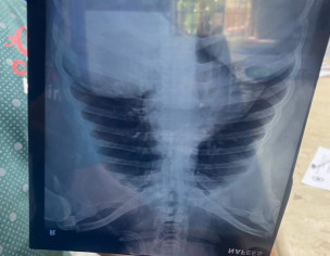 He Got Paralysis Attack