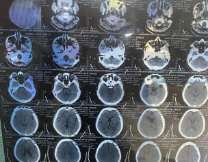 He Got Paralysis Attack