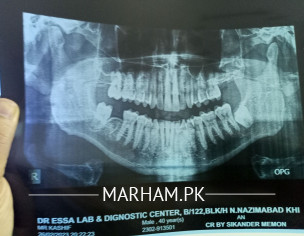 Wisdom Teeth Extraction