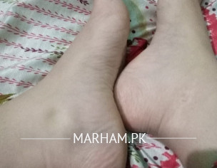 Swelling, Over Weight