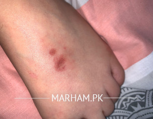 Burn Mark On Skin
