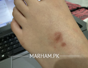 Burn Mark On Skin