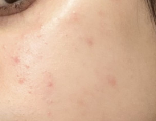 Acne, PIE, Redness