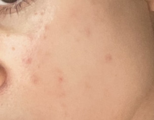 Acne, PIE, Redness