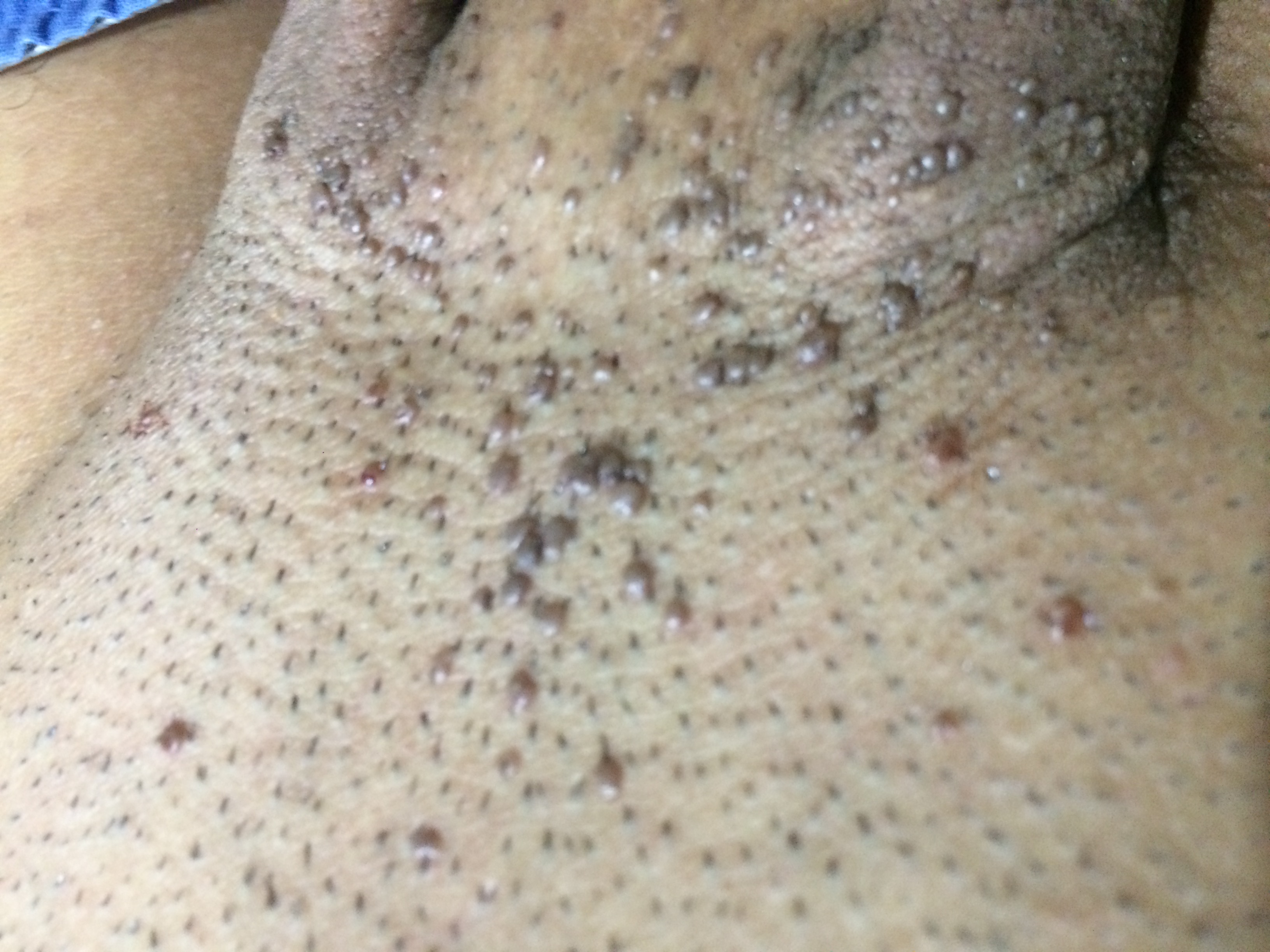 Mole on penis