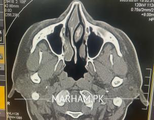 Nose Blockage With Tinatus