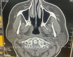 Nose Blockage With Tinatus