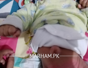 Baby's Bulging Belly Button