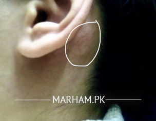 Enlarged Bone Behind Ear