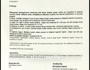 Lymphoma Diagnosed 