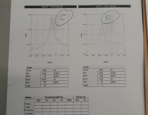 Adenoids Enlargement