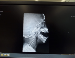 Adenoids Enlargement