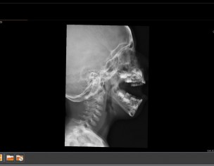 Adenoids Enlargement