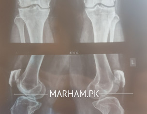 Problem In Knee