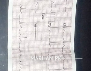 ECG